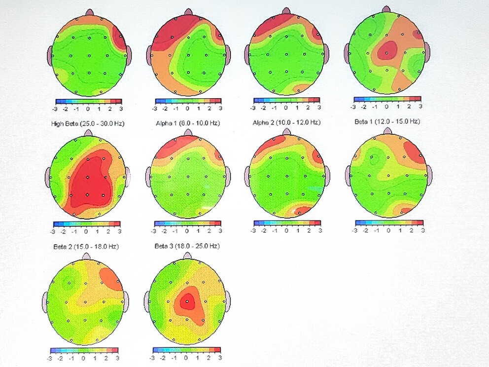 دستگاه QEEG-کاماپرس