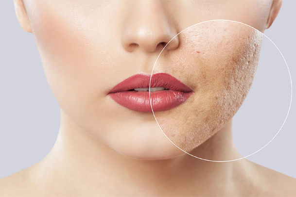 ۴ کرم ضدجوش و آکنه موثر برای پوست صورت