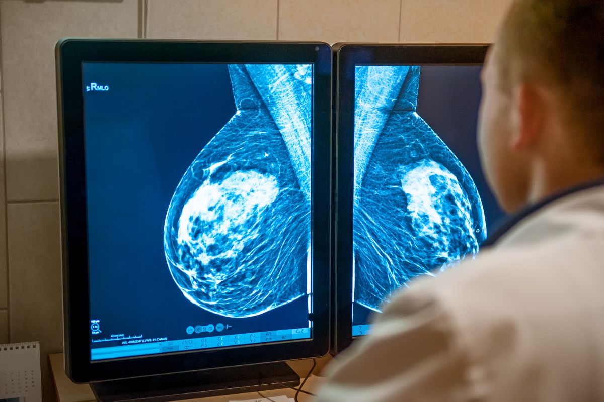 تشخیص سرطان پستان چهار سال پیش از گسترش